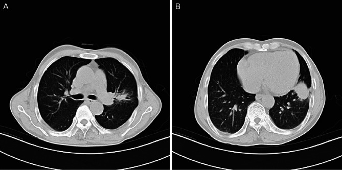 Acute fibrinous and organising pneumonia presenting with mass-like imaging: a case report.