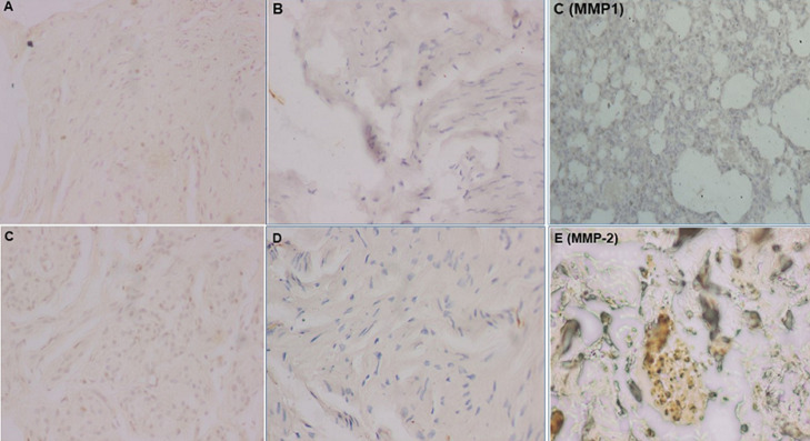 Expression level of matrix metalloproteinases -1, -2 and -9 associated with pelvic organ prolapse: experimental analytical study of round ligaments of Congolese women in two hospitals from the city of Kananga in Democratic Republic of Congo.