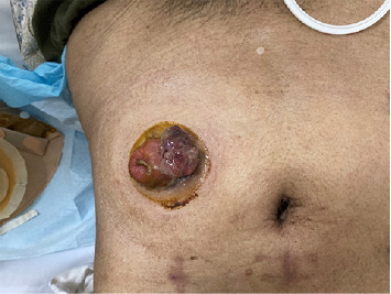 Radiation-Induced Fibrosarcoma in the Stoma: A Case Report and Literature Review.