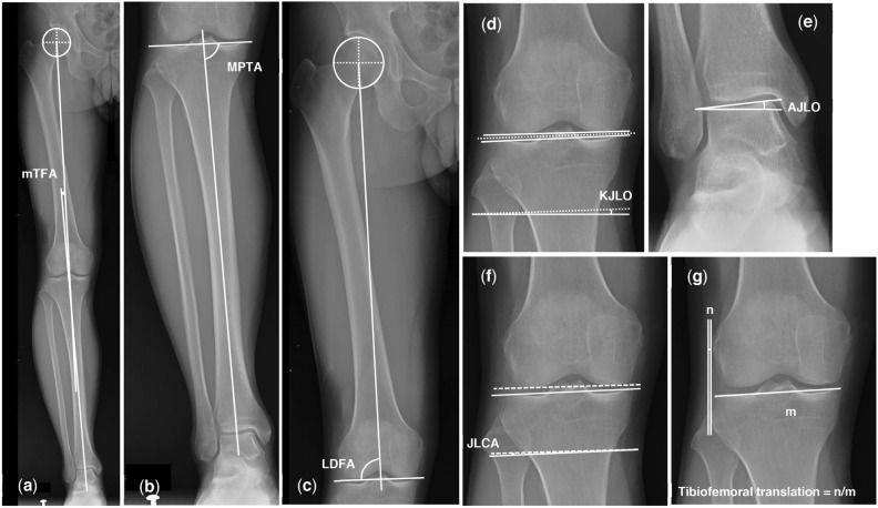 Correction to at least neutral alignment during high tibial osteotomy is sufficient in reducing the knee adduction moment.