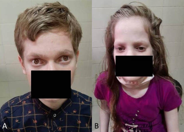 Typical presentation of autosomal recessive oculocutaneous albinism in two siblings.