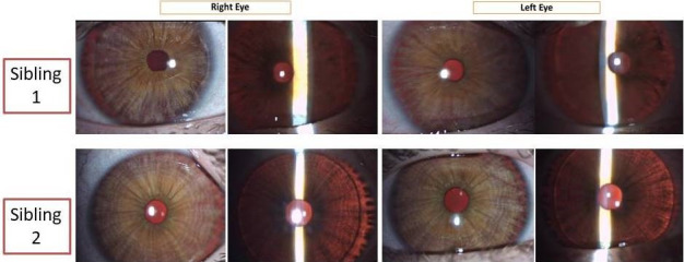 Typical presentation of autosomal recessive oculocutaneous albinism in two siblings.