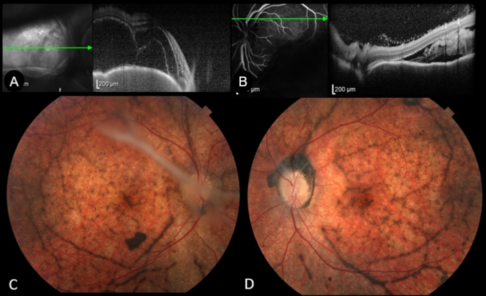 Bacillary layer detachment in acute Vogt-Koyanagi-Harada disease: an early predictor of long-term complications in a Brazilian cohort.