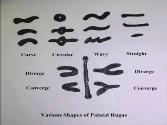 Evaluation of palatal rugae pattern for gender determination and personal identification by comparing simulated antemortem and post mortem records in edentulous patients using a digital method.