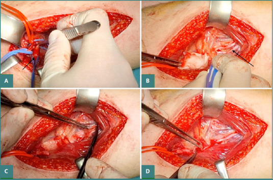Functional outcomes following nerve transfers for shoulder and elbow reanimation in brachial plexus injuries: a 10-year retrospective study.