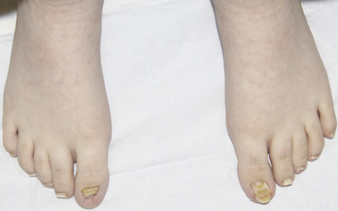 Congenital Malalignment of the Great Toenails with Secondary Retronychia: A Tale of Twin Toenails.