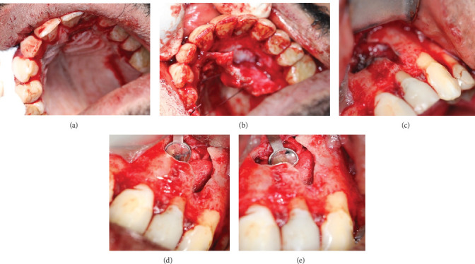 Healing of Extensive Through-and-Through Periradicular Lesion Using Apicoectomy Without Bone Grafting: A Case Report With 3-Year Recall.