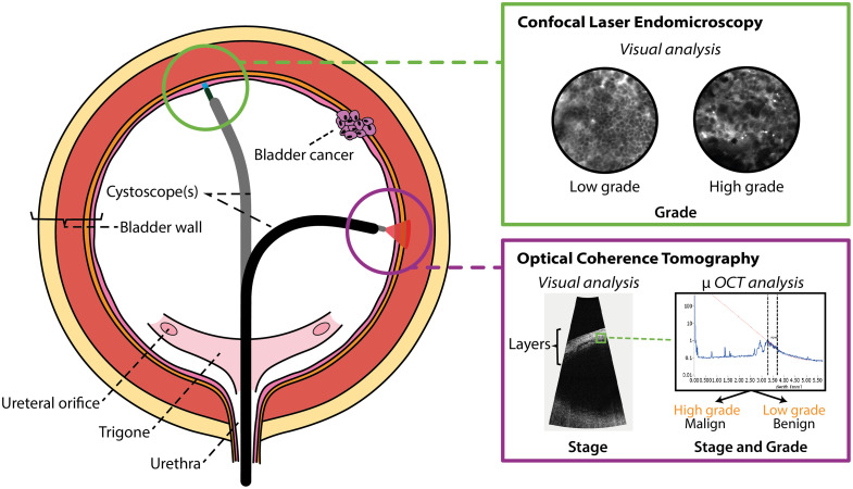 Perspective on the use of optics in bladder cancer detection and diagnosis.