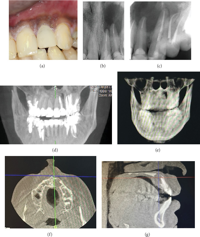 Healing of Extensive Through-and-Through Periradicular Lesion Using Apicoectomy Without Bone Grafting: A Case Report With 3-Year Recall.