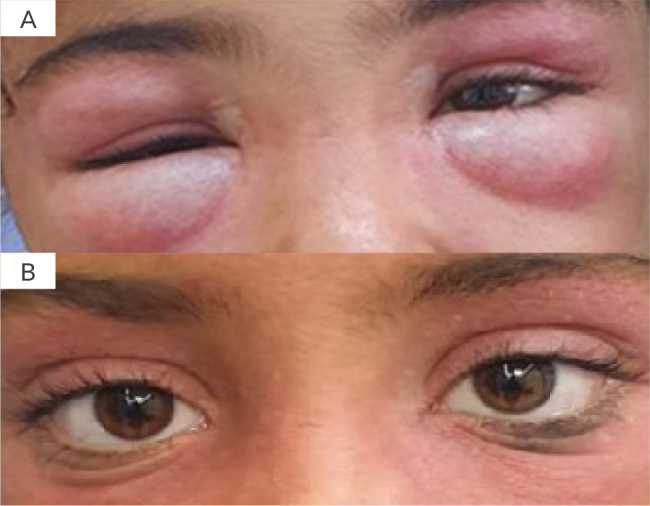 Juvenile Dermatomyositis and Hepatitis B Viral Infection.