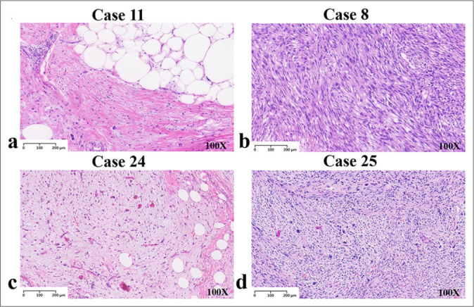 Clinicopathological and molecular diagnostic features of liposarcoma: A study of 27 cases.