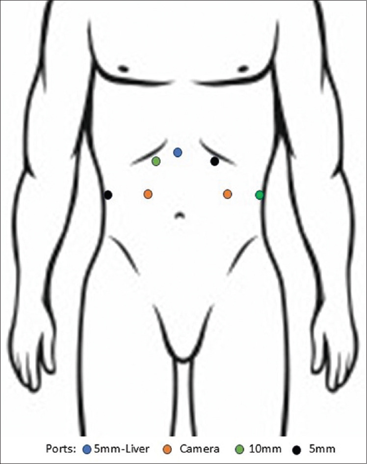 Surgical and functional outcomes of bilateral synchronous adrenalectomy for functional tumors: A cohort study.