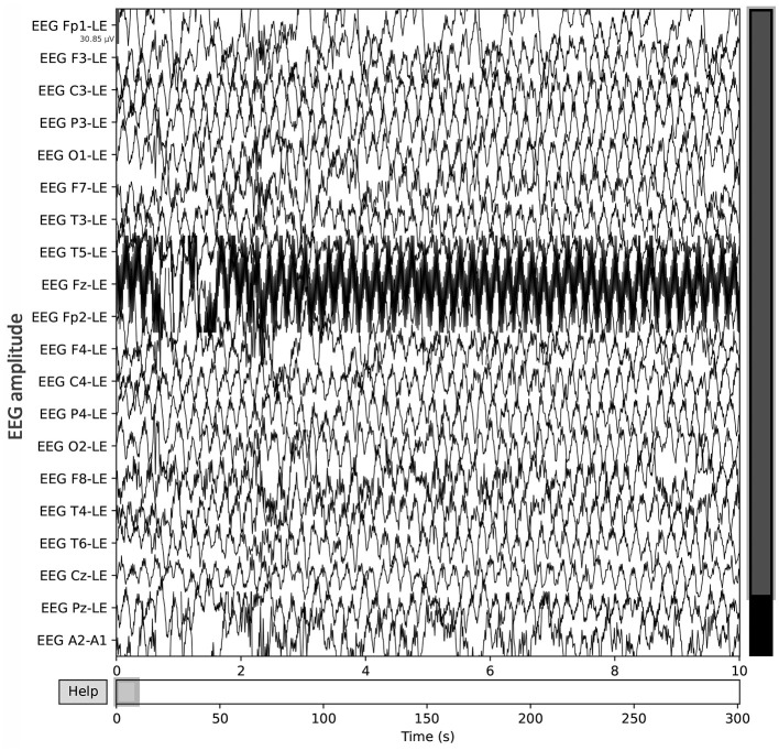 Decentralized EEG-based detection of major depressive disorder via transformer architectures and split learning.
