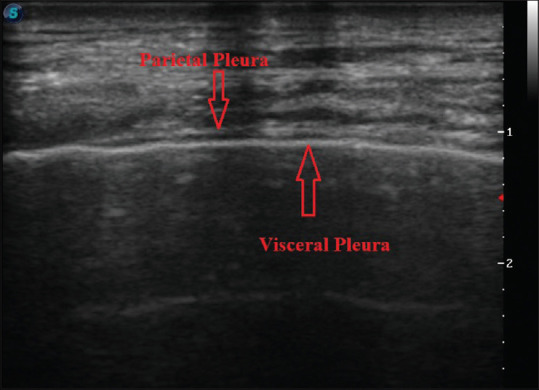 Utilizing thoracic ultrasonography in determining the characteristics of pleural fluid: Development of a novel sonographic scoring system.
