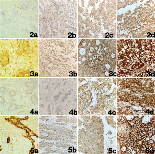 Tumour Budding with Epithelial Mesenchymal Transition Markers - A Novel Prognostic Tool for Breast Carcinoma.