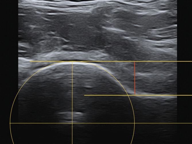 Sonography-based determination of hip joint anterior head-neck offset is reliable and reproducible for CAM deformity assessment.