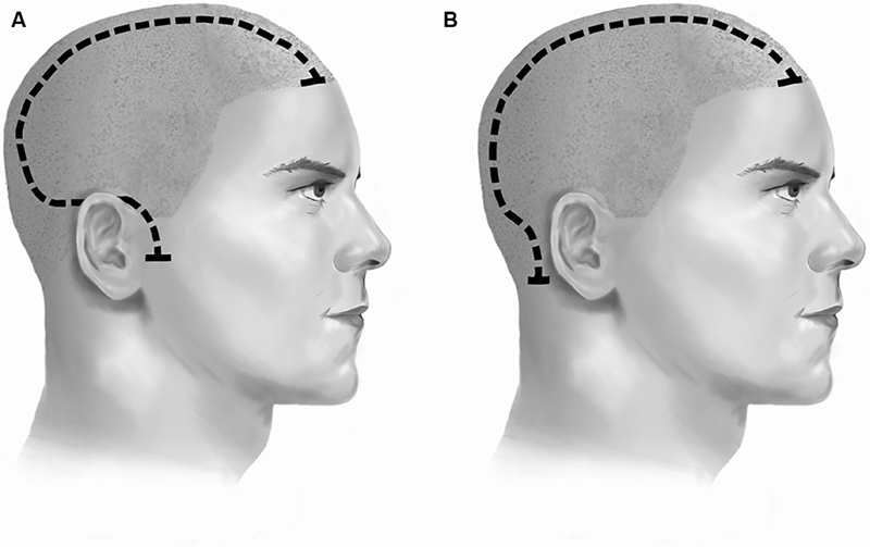 The Question Mark Question: Wound Healing after Hemicraniectomy.