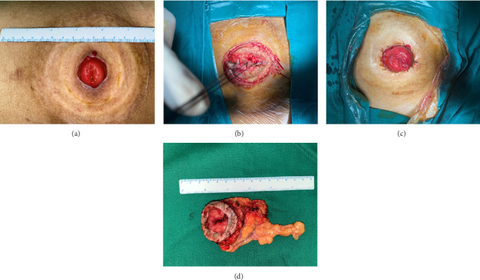 Radiation-Induced Fibrosarcoma in the Stoma: A Case Report and Literature Review.