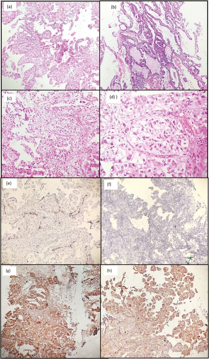 Convention Smears of Pleural Effusion Cytology Revealing Metastatic Clear Cell Carcinoma of Endometrium: A Rare Case Report and Review of Literature.