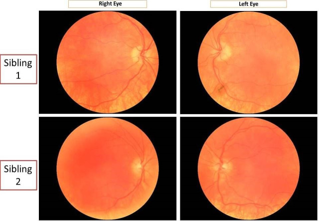 Typical presentation of autosomal recessive oculocutaneous albinism in two siblings.