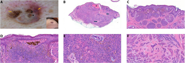 Dermoscopic Features of Eccrine Poromas in Diverse Skin Phototypes: A Retrospective Study of 26 Cases.