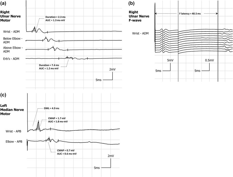 Diverse electrophysiological demyelinating features in a late-onset glycogen storage disease type IIIa case.