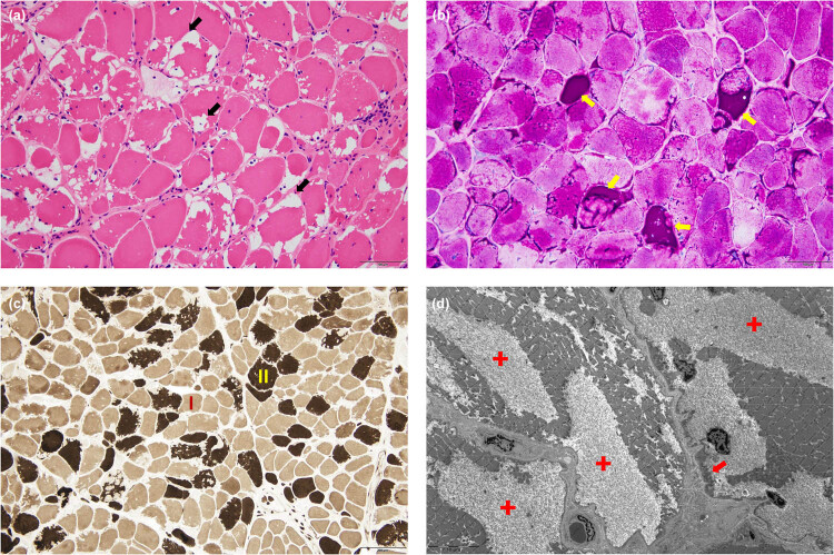 Diverse electrophysiological demyelinating features in a late-onset glycogen storage disease type IIIa case.
