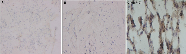 Expression level of matrix metalloproteinases -1, -2 and -9 associated with pelvic organ prolapse: experimental analytical study of round ligaments of Congolese women in two hospitals from the city of Kananga in Democratic Republic of Congo.