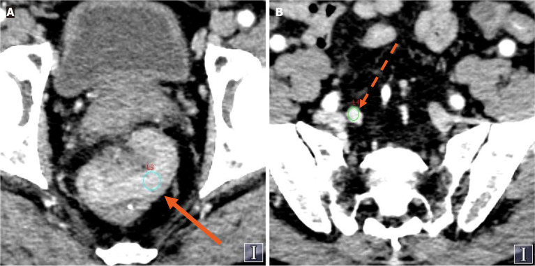 Spectral computed tomography parameters of primary tumors and lymph nodes for predicting tumor deposits in colorectal cancer.