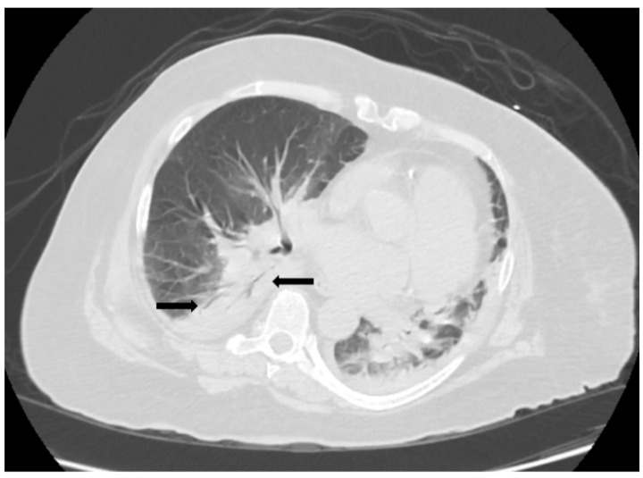 Severe Anaplasmosis with Multi-Organ Failure in a Patient with Splenectomy: A Case Report.
