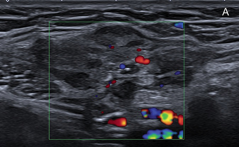 Endometriosis of the Round Ligaments in Twins: A Rare and Unique Presentation.