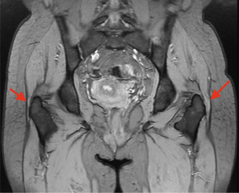 The role of injection collagen therapy in greater trochanter pain syndrome. A new therapeutic approach?