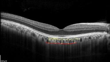 Evaluation of Choroidal Thickness in Type 2 Diabetes Using Spectral-Domain Optical Coherence Tomography.