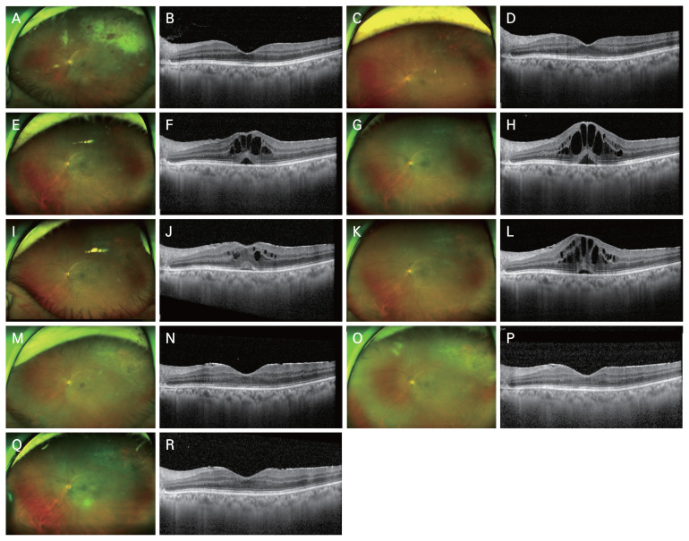 Treatment with Subtenon and Intravitreal Triamcinolone Acetonide for Cystoid Macular Edema after Cytomegalovirus Retinitis: A Case Report.