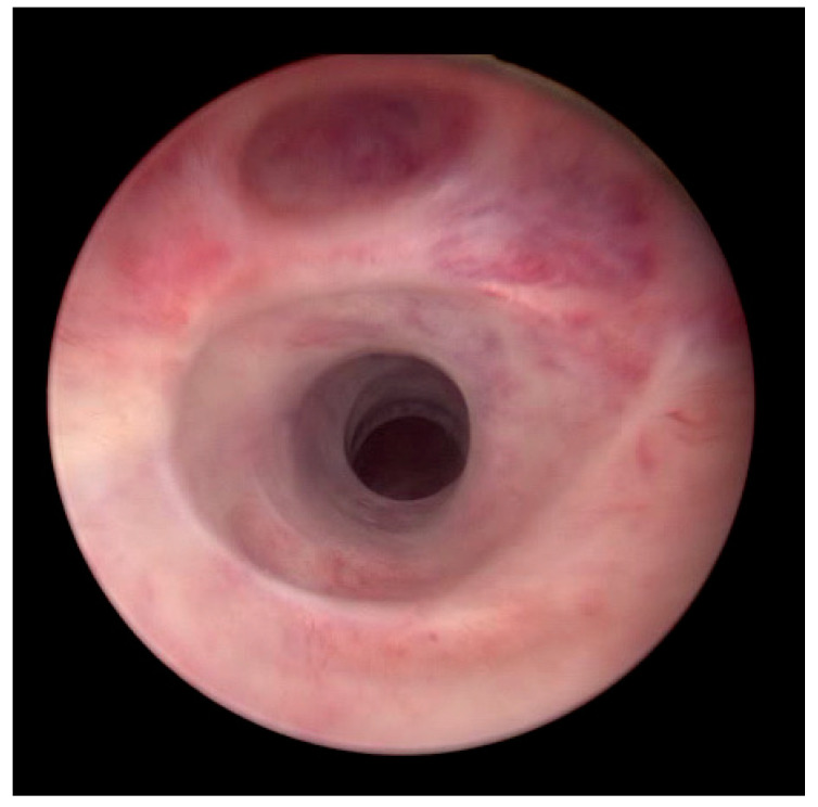 Optilume Drug-Coated Balloon for Acute Urinary Retention After Failed Treatment for Complex Recurrent Urethral Stricture Disease.