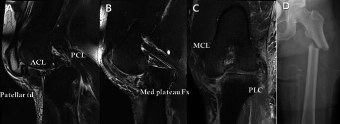 Distinct patterns of ligament and meniscal injuries in multiligamentous knee injuries with and without dislocation: a 15-year retrospective study.