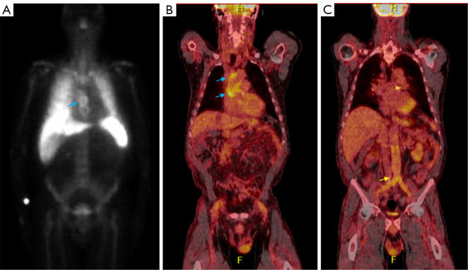 Applications of multi-modality imaging in the diagnosis of infective endocarditis: a real-life case based contemporary narrative review.