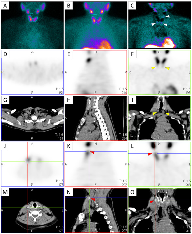 SPECT/CT in addition to subtraction parathyroid scintigraphy in hyperparathyroidism: diagnostic performance in a cohort of predominantly end-stage renal disease patients.