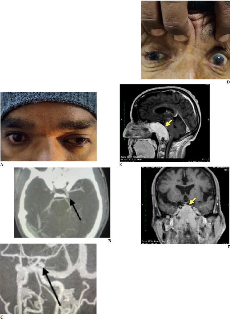 Neurological and neurosurgical conditions presenting first with ophthalmological clinical features: A case series.