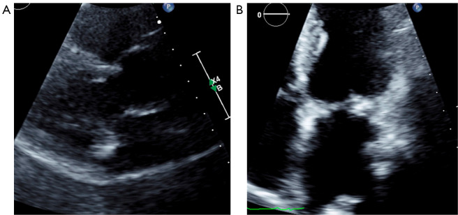 Applications of multi-modality imaging in the diagnosis of infective endocarditis: a real-life case based contemporary narrative review.