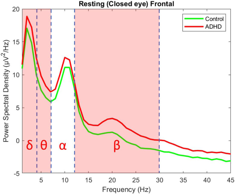 An Electroencephalography Study of Adult Attention Deficit Hyperactivity Disorder and its Association with Insomnia.