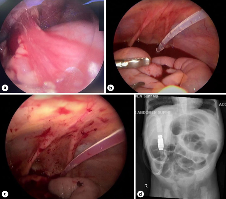 Peritoneal Dialysis Catheter Malfunction due to Adhesion to Ileum: A Case Report.