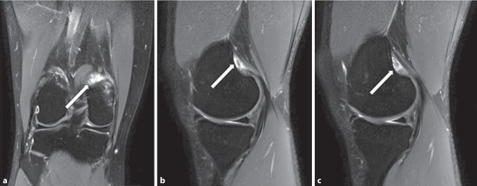 Partial tear of the medial gastrocnemius head : A case report of meniscal symptoms in a 32-year-old recreational athlete.