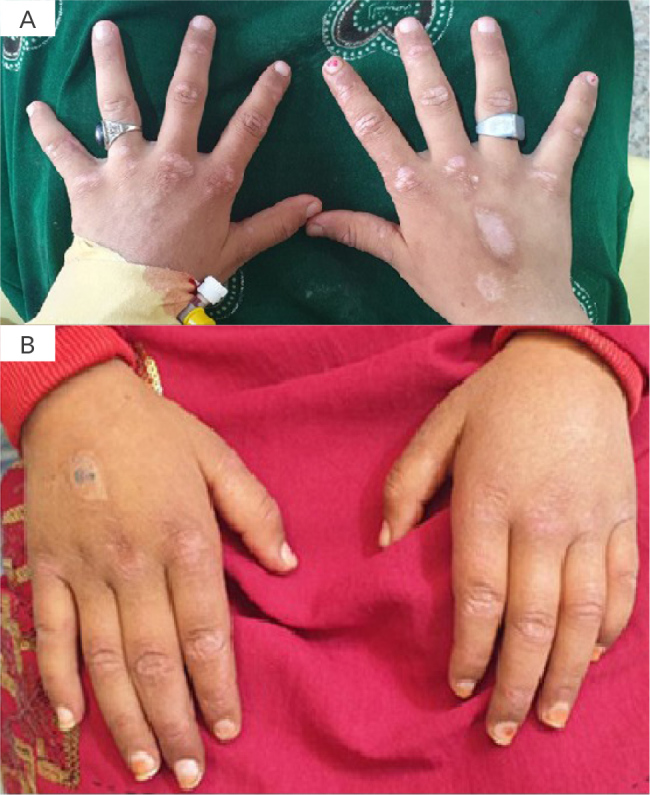 Juvenile Dermatomyositis and Hepatitis B Viral Infection.