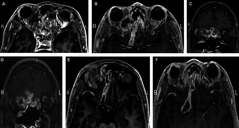 Preoperative Administration of Amphotericin B in Orbital Mucormycosis Management: A Case Report.