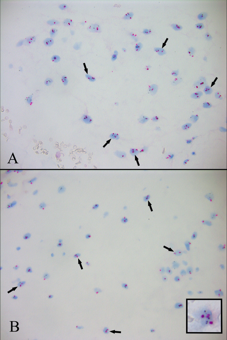 Novel scoring system provides high separation of diploidy and triploidy to aid partial hydatidiform mole diagnosis: an adaption of <i>HER2</i> D-DISH for ploidy analysis.