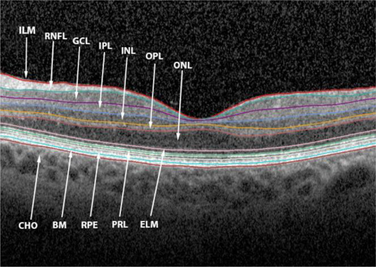 Benefit of continuous positive airway pressure on optic nerve damage in patients with obstructive sleep apnea.