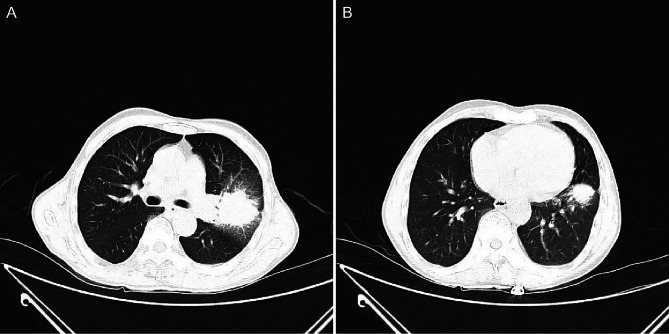 Acute fibrinous and organising pneumonia presenting with mass-like imaging: a case report.