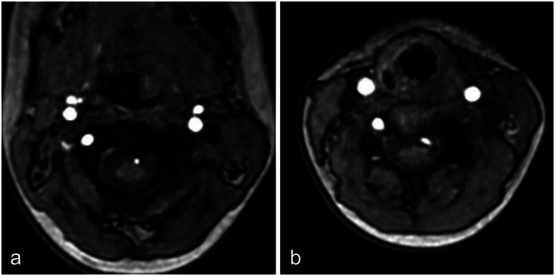 Diagnosis of C5 segmental vertebral artery using magnetic resonance angiography.