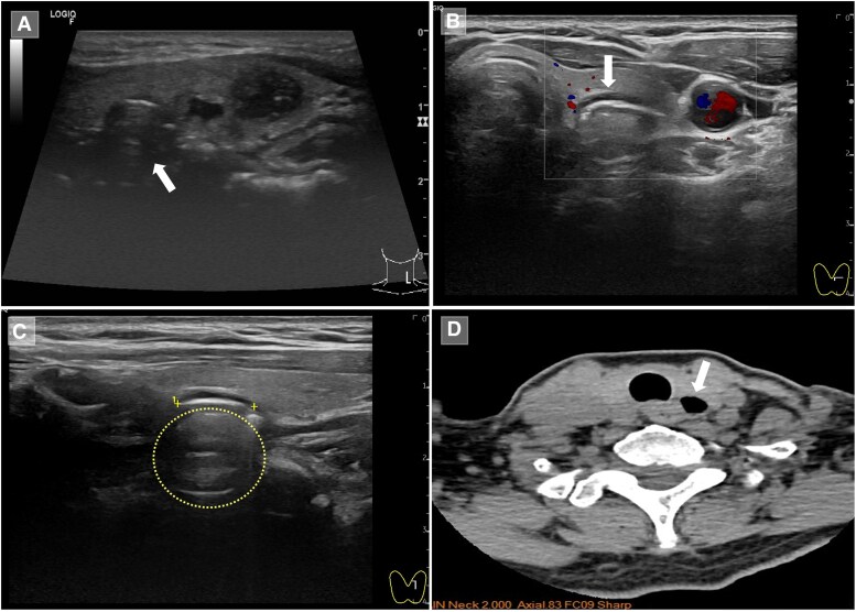 Zenker Diverticulum Masquerading as a Thyroid Nodule.